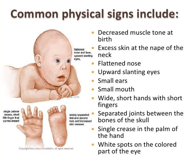 Symptoms and Characteristics of Down Syndrome