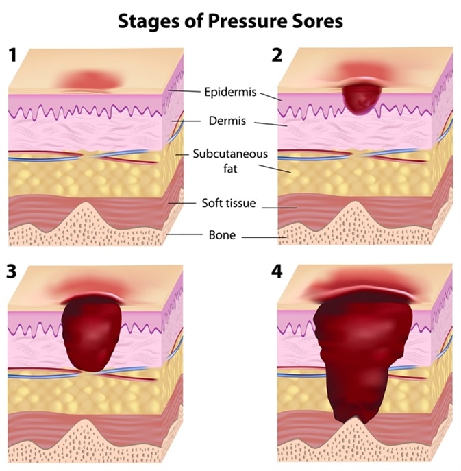 Treatment of a category II pressure ulcer and improved asymmetric