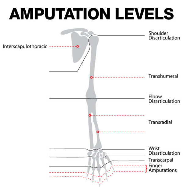 Amputations And Prosthetics Free Trial - Pass The OT