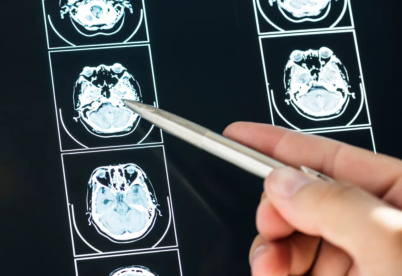 Cerebrovascular Accident (CVA) brain mri scan