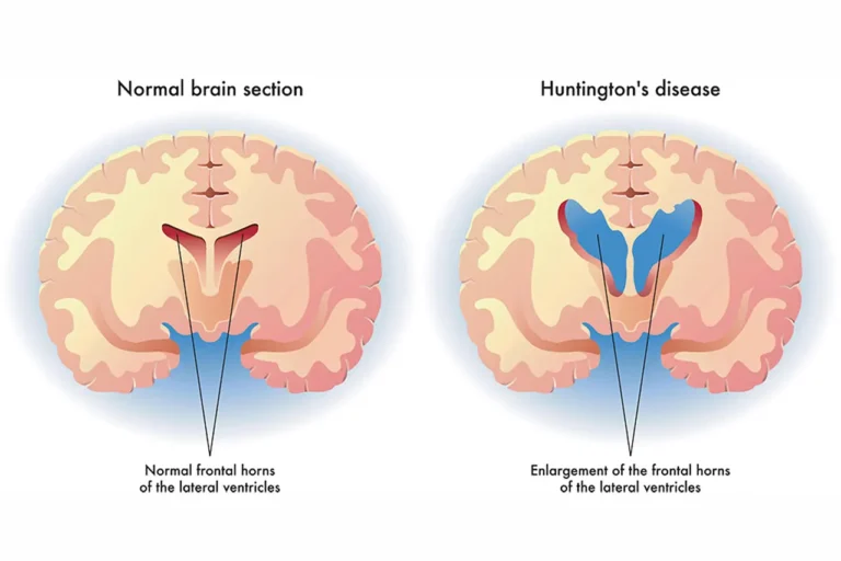 Huntington’s Disease