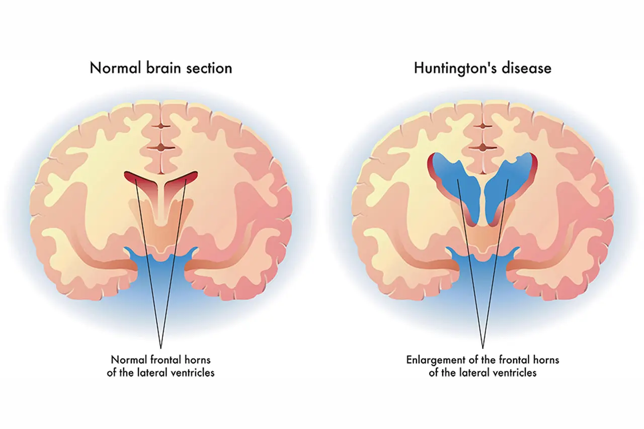 Huntington’s Disease