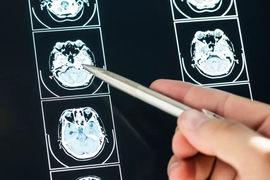Cerebrovascular Accident (CVA) brain mri scan