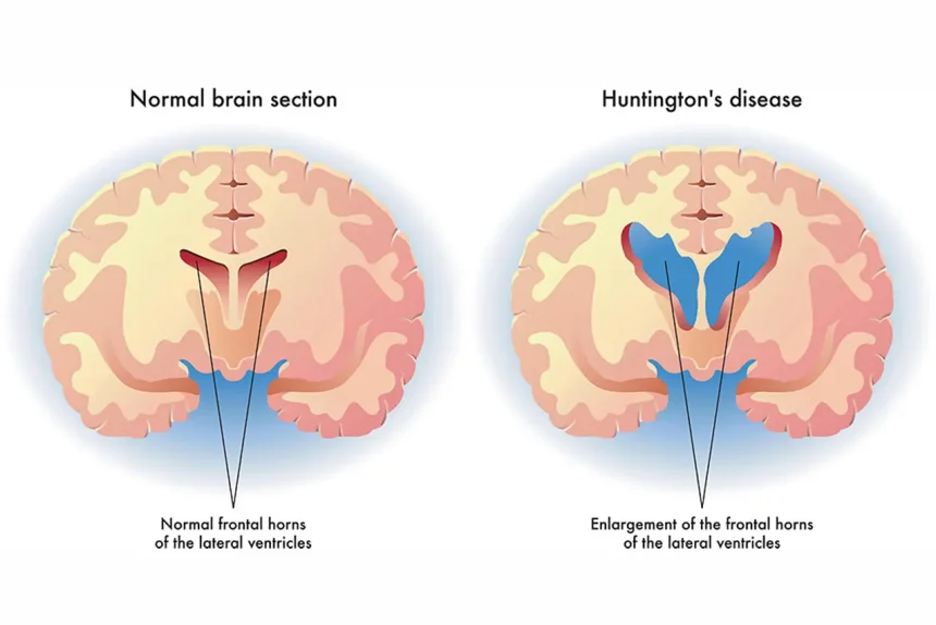Huntington’s Disease