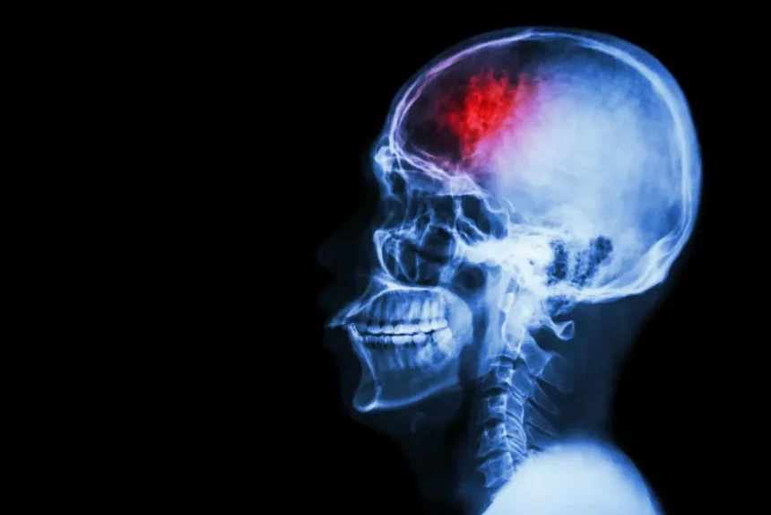 traumatic brain injury - occupational therapy
