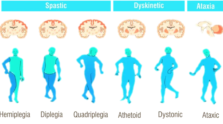 types of Cerebral Palsy